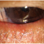 Meibomian gland dysfunction: slit-lamp photograph of the eyelid margin with hyperemia, lash debris, and gland orifice changes