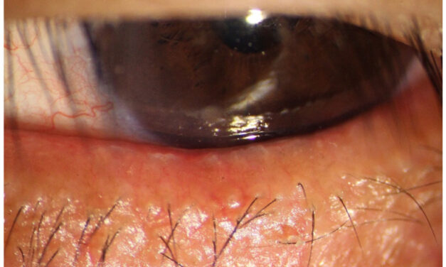Meibomian Gland Dysfunction: The Oil Problem Behind Most Dry Eye