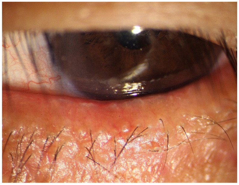 Meibomian Gland Dysfunction: The Oil Problem Behind Most Dry Eye