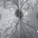 MEK Inhibitor-Associated Retinopathy: clinical photograph