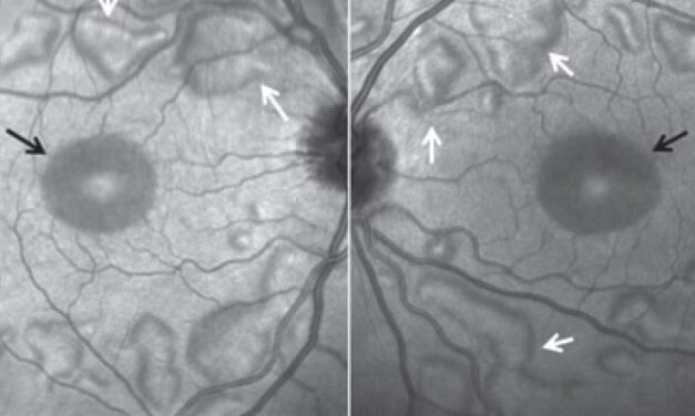 MEK Inhibitor-Associated Retinopathy: Serous Detachments in Patients on Targeted Cancer Therapy