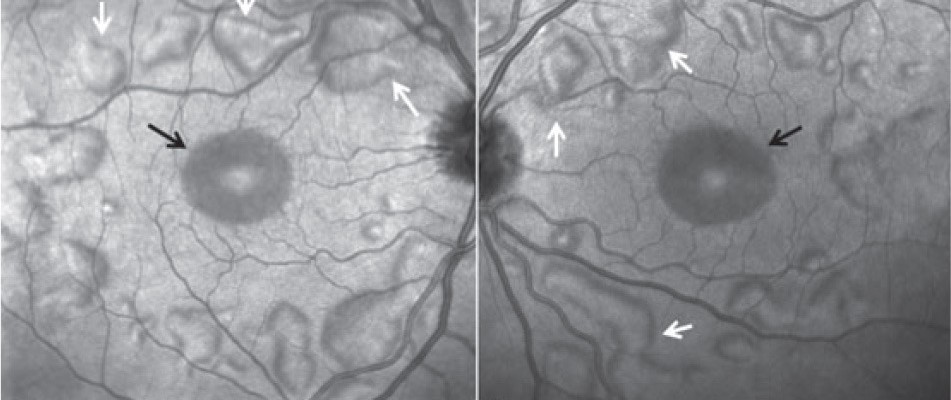 MEK Inhibitor-Associated Retinopathy Clinical Photograph 1 MEK Inhibitor-Associated Retinopathy: clinical photograph