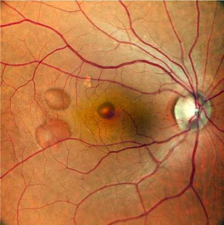 MEK Inhibitor-Associated Retinopathy Clinical Photograph 2 MEK Inhibitor-Associated Retinopathy: clinical photograph, second view