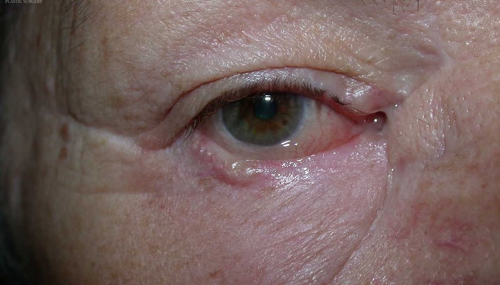 Chemosis