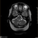 Millard-Gubler syndrome: axial MRI showing a small brainstem infarct at the pontomedullary junction (arrow)