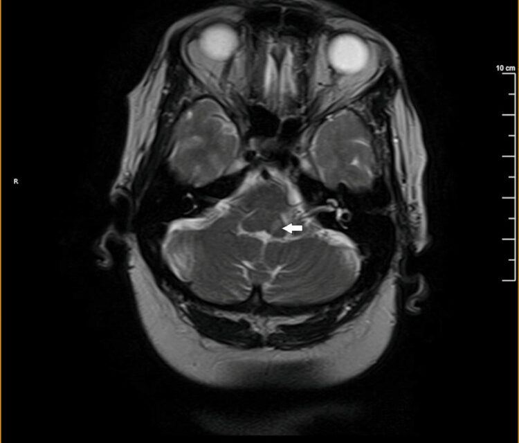 Millard-Gubler Syndrome: The Pontine Stroke Without the Gaze Palsy