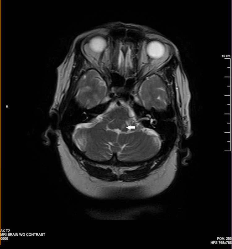 Millard-Gubler Syndrome Brainstem Infarct MRI Millard-Gubler syndrome: axial MRI showing a small brainstem infarct at the pontomedullary junction (arrow)