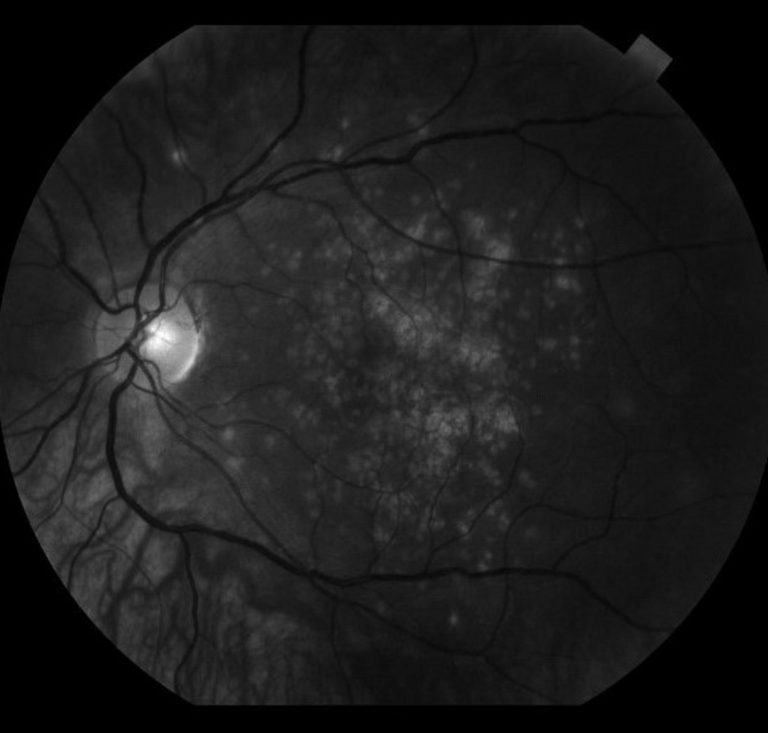 Multifocal choroiditis and panuveitis: fundus autofluorescence image showing hypoautofluorescent chorioretinal lesions