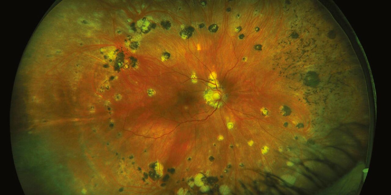 Multifocal Choroiditis and Panuveitis: The White Dot Syndrome That Doesn’t Just Go Away