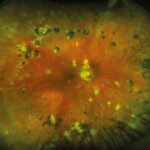 Multifocal choroiditis and panuveitis: widefield fundus photograph showing multiple round chorioretinal lesions