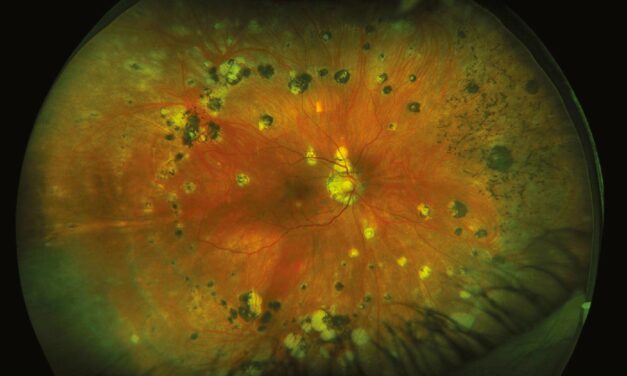 Multifocal Choroiditis and Panuveitis: The White Dot Syndrome That Doesn’t Just Go Away