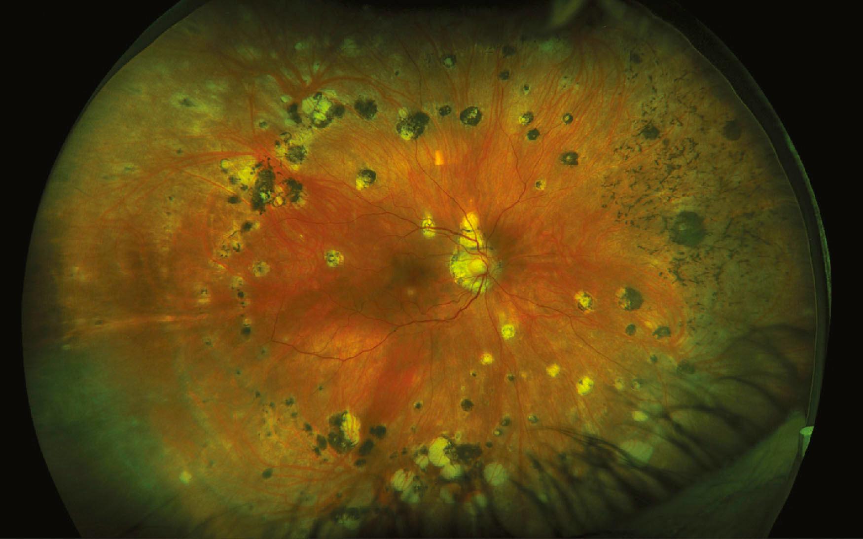 Multifocal choroiditis and panuveitis: widefield fundus photograph showing multiple round chorioretinal lesions