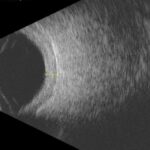 B-scan Ultrasonography