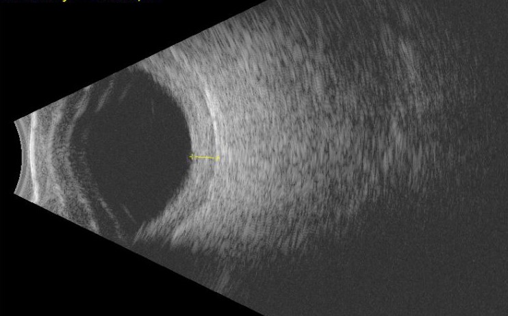 B-scan Ultrasonography: Seeing Past What the Fundus Exam Cannot
