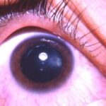 Nanophthalmos: anterior segment photograph showing a small eye with a crowded anterior chamber