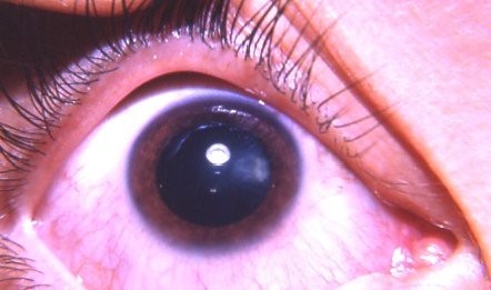 Nanophthalmos: The Small Eye With a Thick, Risky Sclera