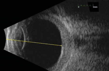 Nanophthalmos: B-scan ultrasonography showing a short axial length and thickened sclera