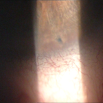 Nd:YAG laser peripheral iridotomy: slit-lamp view of the peripheral iris and angle during laser iridotomy