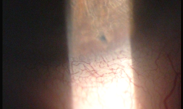 Laser Peripheral Iridotomy: Fixing Pupillary Block, and Only Pupillary Block