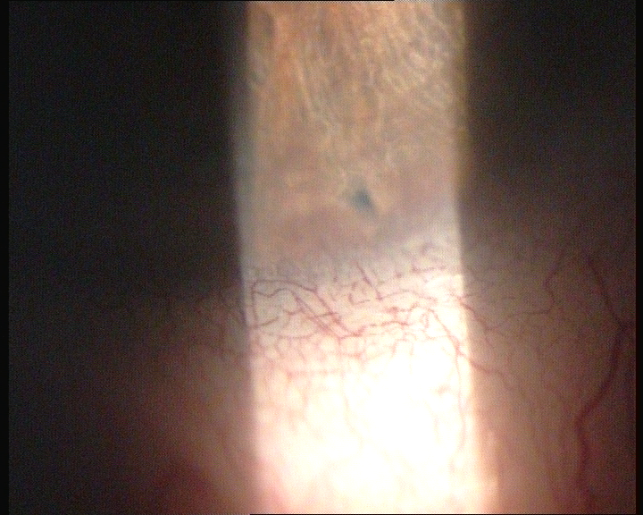 Nd:YAG Laser Peripheral Iridotomy Slit Lamp View Nd:YAG laser peripheral iridotomy: slit-lamp view of the peripheral iris and angle during laser iridotomy