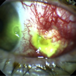 Clinical eye photograph illustrating Necrotizing Scleritis Immunosuppression