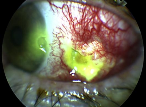 Necrotizing Scleritis: Why Immunosuppression, Not Just Steroids, Is the Treatment