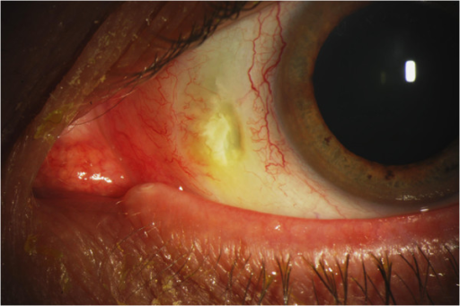 Clinical eye photograph illustrating Necrotizing Scleritis Immunosuppression