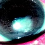 Clinical eye photograph illustrating Neurotrophic Keratitis Staging Treatment