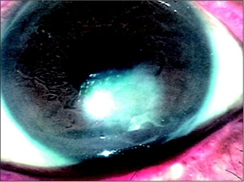 Neurotrophic Keratitis: Staging a Disease That Hurts the Cornea More Than the Patient