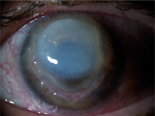 Clinical eye photograph illustrating Neurotrophic Keratitis Staging Treatment
