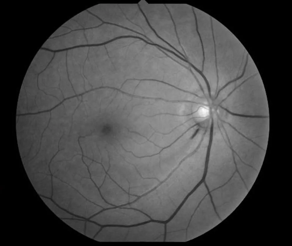 Normal-tension glaucoma: fundus photograph showing a splinter disc hemorrhage
