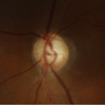 Normal-tension glaucoma: fundus photograph showing a focal neuroretinal rim notch of the optic disc