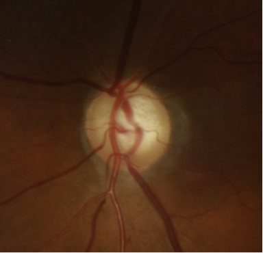 Normal-Tension Glaucoma: Damage Without the High Pressure