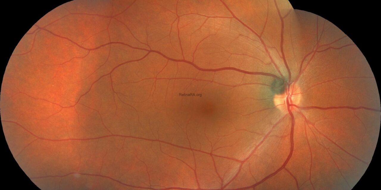 Occult Macular Dystrophy: Progressive Central Vision Loss With a Normal-Looking Macula