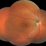 Occult Macular Dystrophy: clinical photograph