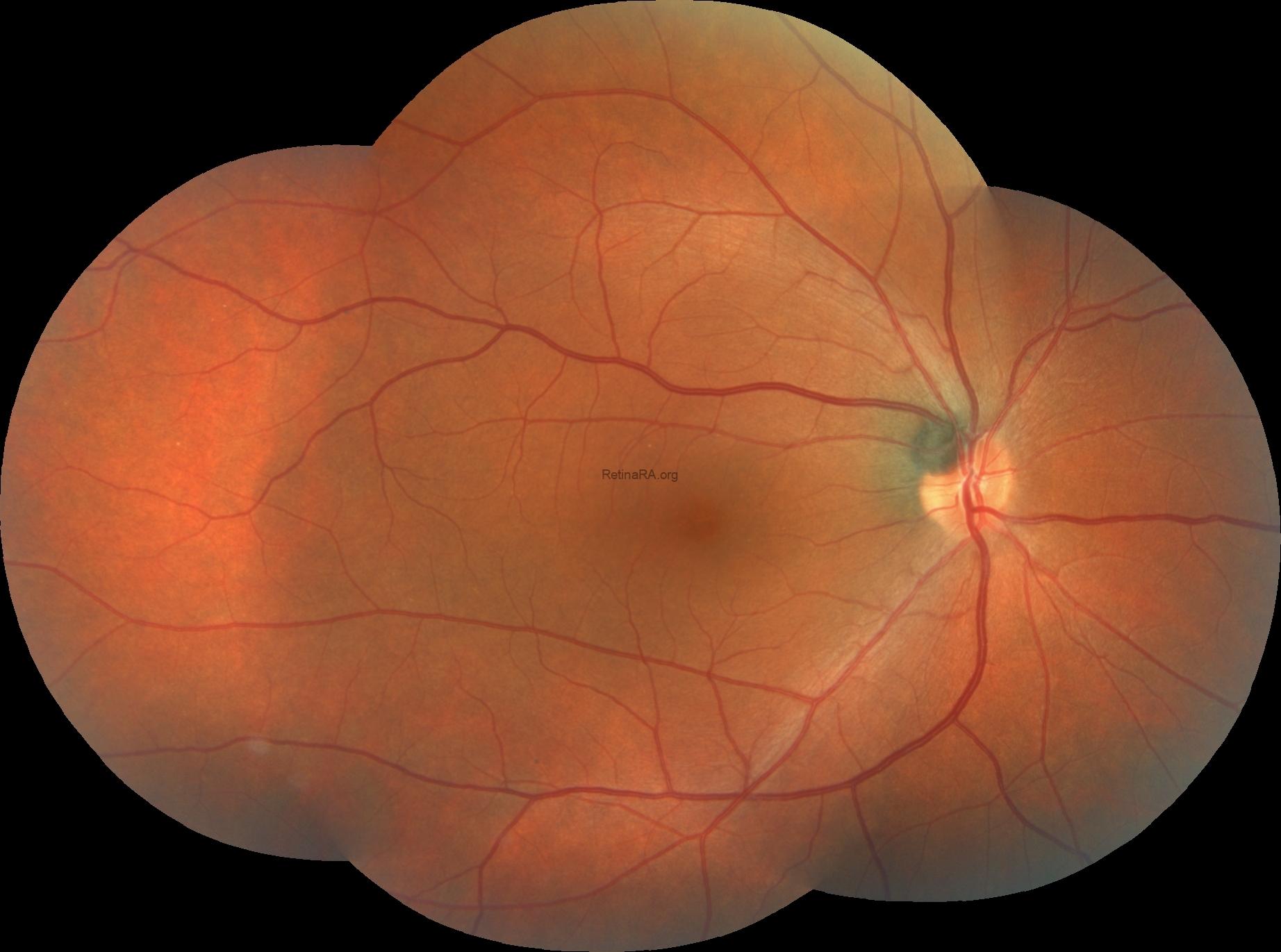 Occult Macular Dystrophy Clinical Photograph 1 Occult Macular Dystrophy: clinical photograph
