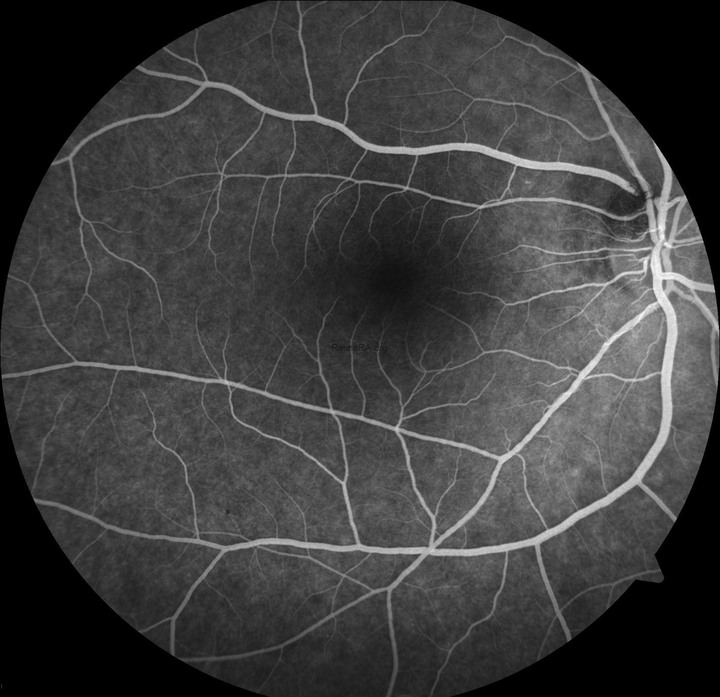 Occult Macular Dystrophy Clinical Photograph 2 Occult Macular Dystrophy: clinical photograph, second view