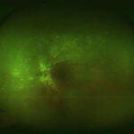 Ocular Brucellosis: clinical photograph