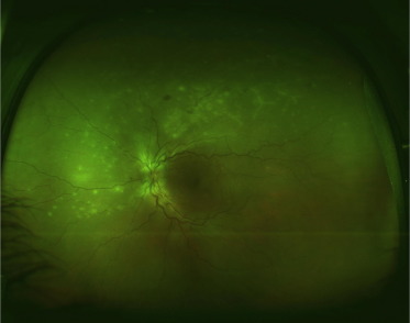 Ocular Brucellosis: Uveitis in a Patient With Fever, Sweats and Raw Dairy in the History