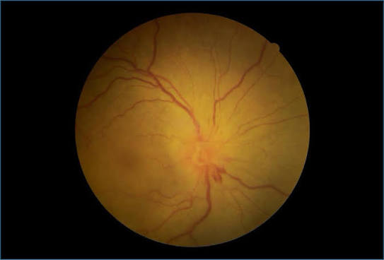 Ocular Brucellosis Clinical Photograph 2 Ocular Brucellosis: clinical photograph, second view