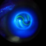 Ocular hypertension: view through the slit lamp of the fluorescein mires during Goldmann applanation tonometry
