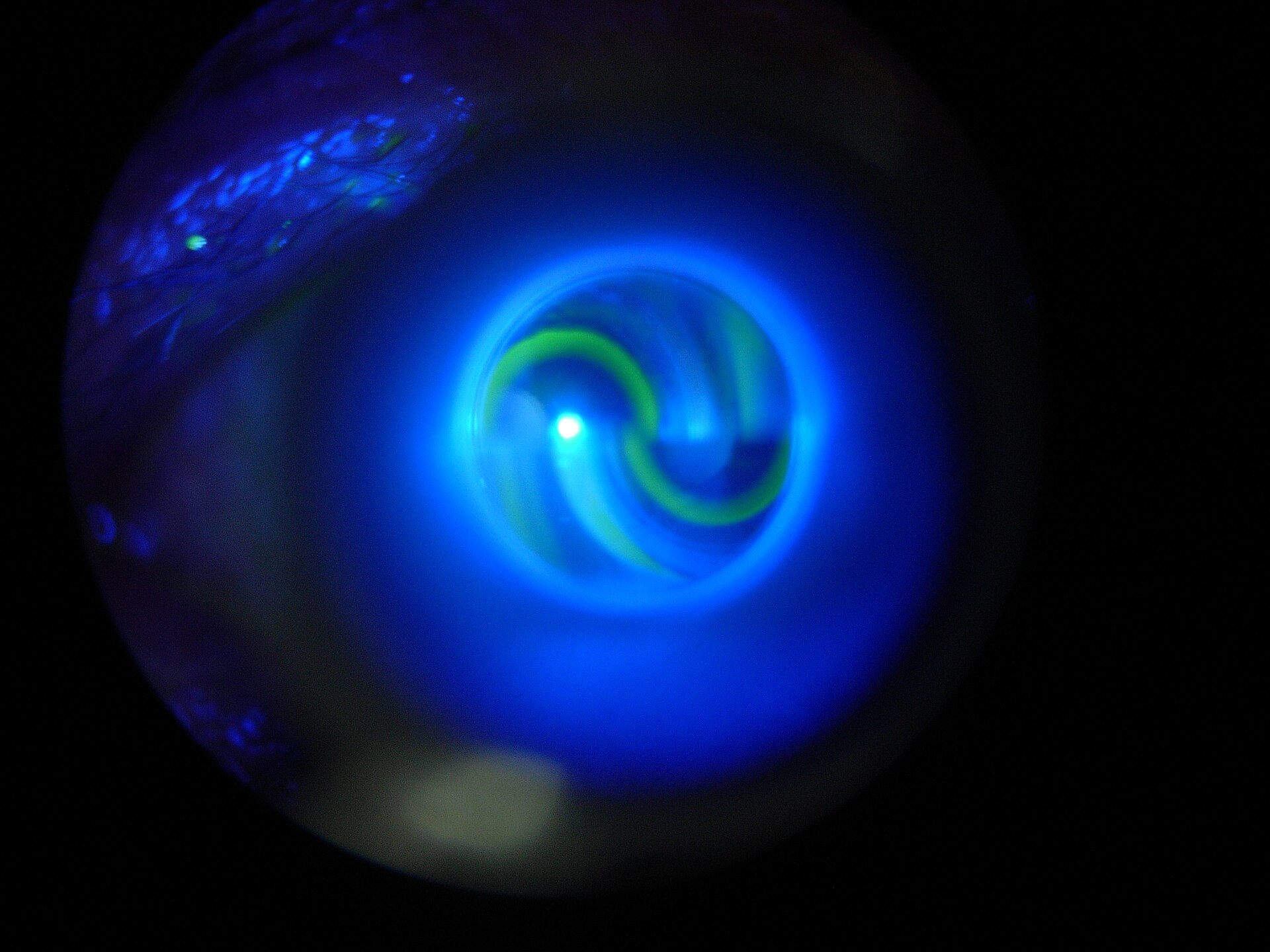 Ocular hypertension: view through the slit lamp of the fluorescein mires during Goldmann applanation tonometry
