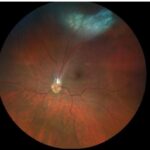 Ocular toxocariasis: fundus photograph showing a peripheral whitish granuloma with retinal vessels drawn toward it