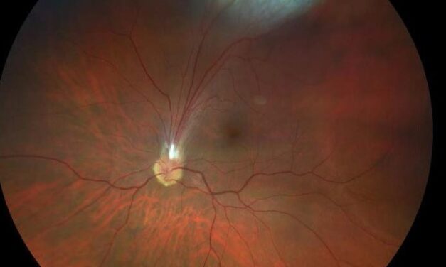 Ocular Toxocariasis: The Retinoblastoma Mimic From a Dog Roundworm