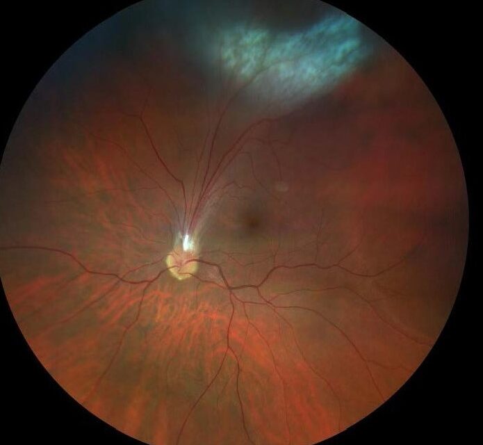 Ocular Toxocariasis: The Retinoblastoma Mimic From a Dog Roundworm