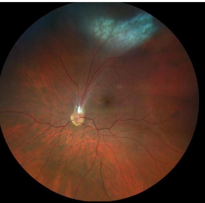 Ocular toxocariasis: fundus photograph showing a peripheral whitish granuloma with retinal vessels drawn toward it