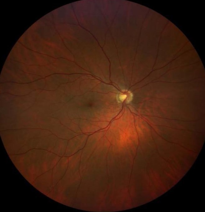 Ocular toxocariasis: fundus photograph of the left eye with a whitish peripheral lesion