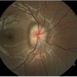 Optic disc drusen: fundus photograph showing an elevated optic disc with blurred margins and drusen (arrow)