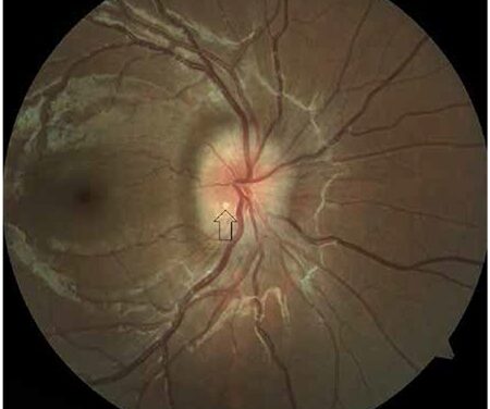 Optic Disc Drusen: The Benign Mimic of Papilledema