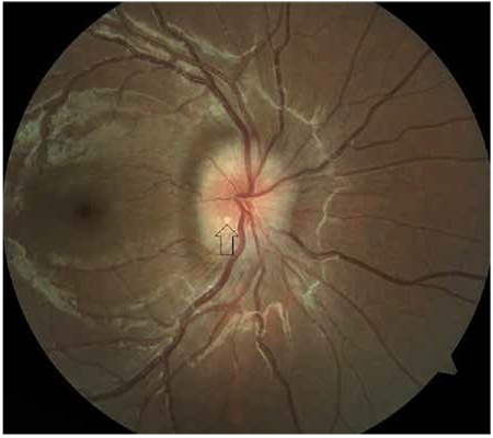 Optic Disc Drusen Elevated Disc Optic disc drusen: fundus photograph showing an elevated optic disc with blurred margins and drusen (arrow)